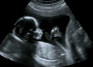 baby-ultraschall